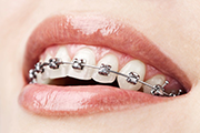 Meilleure mutuelle orthodontie