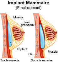 Remboursement chirurgie mammaire